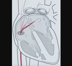 Atraverse Medical Hotwire radiofrequency (RF) guidewire