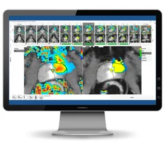 Profound Medical prostate ablation contouring assistant