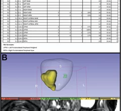 AI assistance improve prostate cancer margin definition