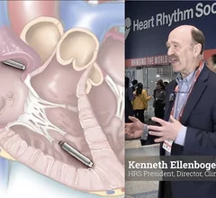 Heart Rhythm Socity (HRS) President Kenneth Ellenbogen, MD, explains key electrophysiology (EP) trends at the HRS 2024 meeting. #HRS #HRS24 #HRS2024 #EPeeps
