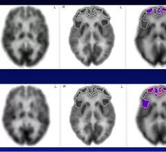 Hearing aids help slow brain aging in individuals with mild cognitive impairment