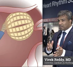 Vivek Reddy, MD, Director, Cardiac Arrhythmia Service, and the Leona M. and Harry B. Helmsley Charitable Trust Professor of Medicine in Cardiac Electrophysiology, at Mount Sinai in New York, was involved in most of the late-breaking pulsed field ablation (PFA) trials at the Heart Rhythm Society (HRS) 2024 meeting. He offers an overview of the new data presented and his observations from using PFA. #HRS24 #HRS2024 #PFA #EPeeps