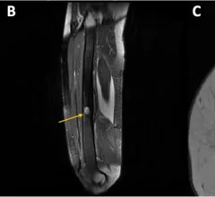 osseous lesion on MRI.