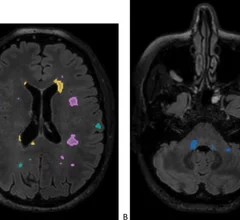 Multiple sclerosis lesions detected with AI assistance