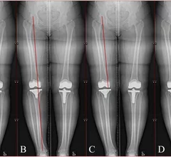 AI can accurately complete leg length and angular measurements