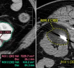 renal cryoablation volumes