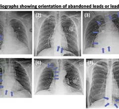 Some of the abandon leads and various shapes and positions on the wires from the study. None of these patients had any safety issues related the abandoned leads. Image courtesy of RSNA