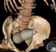 CT scan of a Coca-Cola bottle rectal foreign body. There are a sizable number of emergency room cases each year for items people insert into their rectums that become lodged or lost inside the colon. This includes many types of household items beyond vibrators and commercially made butt plugs. Ghonaim E, Rectal foreign body. Case study, Radiopaedia.org.