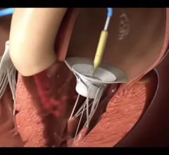 Innovalve Bio Medical's Innostay TMVR device. Edwards Lifesciences has agreed to acquire Innovalve after an initial investment in 2017.