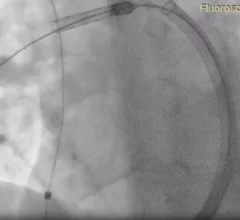 Restore Medical ContraBand medical device heart failure