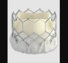 Edwards Lifesciences Sapien 3 transcatheter heart valve used for Mitral Valve-in-Valve