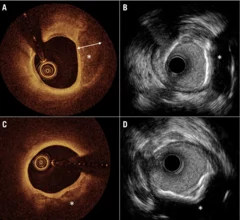 Images coronary calcium imaging by optical coherence tomography (OCT) and high-definition intravascular ultrasound (IVUS). 