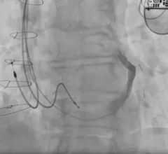 Interventional cardiologists in Canada have performed the world’s first implant of a new coronary sinus reducer designed to treat chest pain patients who see no benefits from other available interventional or surgical treatments. The A-Flux Reducer System was designed and developed by VahatiCor, a new medical device company associated with California-based T45 Labs. 