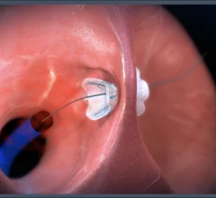 V-Wave has gained considerable attention or its Ventura Interatrial Shunt System, a small implantable device designed to reduce pressure on the left atrium and the lungs in patients with heart failure with reduced ejection fraction (HFrEF). The Ventura device includes a nitinol hourglass-shaped frame that anchors to the patient’s fossa ovalis in a way that prevents migration or embolization. It is implanted via an interventional procedure with fluoroscopy and echocardiography guidance. 