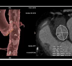 TAVR planning with GE Healthcare's Valve Assist 2 technology