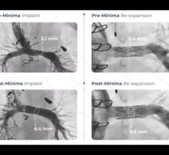 Renata Medical, a California-based healthcare technology company, has gained U.S. Food and Drug Administration (FDA) approval for a new stent specifically designed for pediatric patients with congenital heart defects. The Minima Growth Stent was built to treat newborns, infants and young children, and then it continues to expand as the patient ages