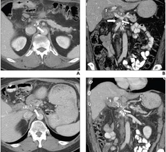 CT findings linked with pancreatic cancer