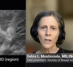 Video interview with Debra Monticciolo, MD, on the expansion of DBT and reducing breast imaging recall rates.
