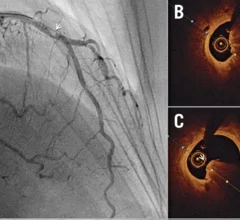 OCT-guided PCI, or optical coherence tomography-guided percutaneous coronary intervention. 