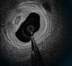 SpectraWAVE, a Massachusetts-based imaging company focused on treatments for patients with coronary artery disease (CAD), has closed a $50 million funding round. Johnson & Johnson Innovation led the round, and other participants included S3 Ventures, Lumira Ventures, SV Health Investors, Deerfield Management, NovaVenture and Heartwork Capital.