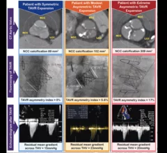 Balloon-expandable transcatheter aortic valve replacement (TAVR) valves that fail to expand symmetrically may be associated with worse hemodynamic data, according to a new analysis published in JACC: Cardiovascular Interventions.