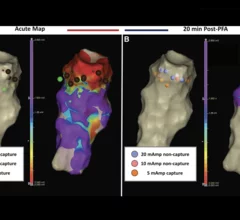 Focal pulsed field ablation (PFA) is a safe, effective treatment option for premature ventricular contractions (PVC), according to new data published in Circulation: Arrhythmia and Electrophysiology.[1]