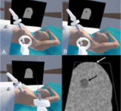 VR helps radiology trainees practice breast biopsy skills