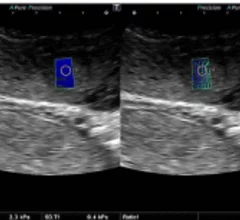 Ultrasound shear-wave elastography predict fetal growth abnormalities earlier than routine obstetric exams.