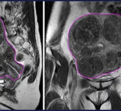 uterine fibroid embolization w/nerve block