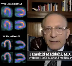 AURORA trial results for Flurpiridaz F-18 PET vs. SPECT discussed by principal investigator Jamshid Maddahi, MD.