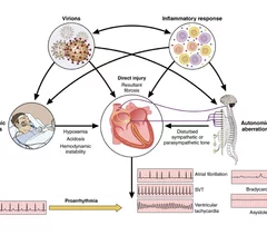 Overview of the pathophysiological mechanisms associated with arrhythmogenesis in the setting of COVID-19 infection. Image from Circulation.
