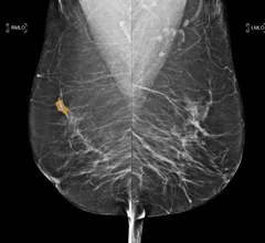 MedCognetics CogNet AI-MT technology is the first embedded AI cancer detection system built into the mammography system to eliminate eliminates latency and delivering immediate, high-quality image analysis and can help prioritize exams in the worklist