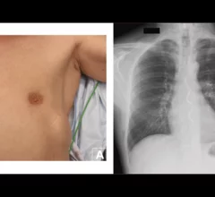 Cardiologists have performed what they believe to be the world’s first substernal lead extraction, sharing their experience in JACC: Case Reports.[1]The device being extracted, Medtronic’s Aurora EV-ICD, received U.S. Food and Drug Administration (FDA) approval in October 2023.