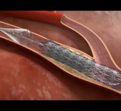 Contego Medical, a North Carolina-based medical device company, has received U.S. Food and Drug Administration (FDA) approval for its new all-in-one carotid stenting offering, the Neuroguard IEP System