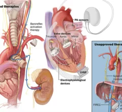 Advanced device-based therapies are associated with significant benefits for heart failure patients and should be used alongside traditional pharmaceutical treatments, according to a new scientific statement from the Heart Failure Society of America (HFSA). The statement, published in full in the Journal of Cardiac Failure, examines a number of new-look medical devices that have emerged in recent years as additional ways to treat heart failure.