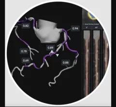 HeartFlow Plaque Analysis Example