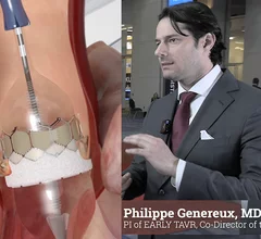 Philippe Genereux explains how EARLY TAVR will help raise awareness for undertreatment of TAVR.