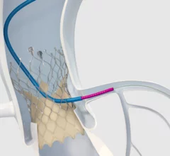 Medtronic_Coronary access