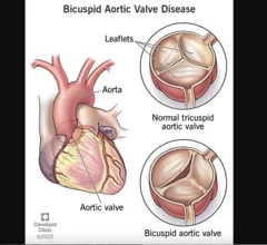 bicuspid aortic valve disease TAVR 