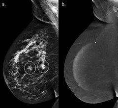 Non-enhancing asymmetries on contrast-enhanced mammography