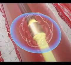 The use of intravascular lithotripsy (IVL) during percutaneous coronary intervention (PCI) is still safe and effective when patients present with calcified nodules (CNs), according to new long-term data published in EuroIntervention.[1] Researchers compared outcomes from patients with and without CNs, highlighting key similarities in stent expansion and luminal gain.