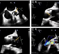 Cardiologists in Spain encountered an unexpected complication in a 78-year-old transcatheter aortic valve replacement (TAVR) patient, highlighting the experience in JACC: Cardiovascular Interventions.