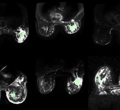 CDI technique makes breast cancer glow on imaging.