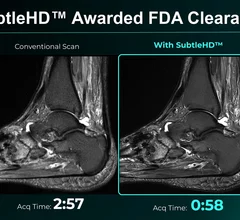 SubtleHD receives FDA clearance for AI-powered MRI solutions
