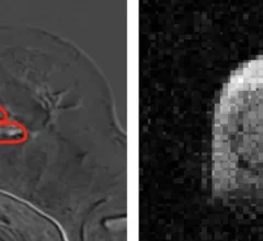 FCI scanner more ably detects cancer spread than traditional MRI