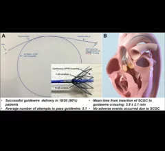 self-centering guide catheter (SCGC) for TAVR from Boston Scientific 