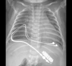 pediatric pacemaker