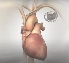 Orchestra BioMed Holdings AVIM Therapy FDA breakthrough device