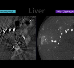 GE Healthcare's CleaRecon DL reduces IR image artifacts during procedures