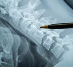Spine X-ray spinal cord